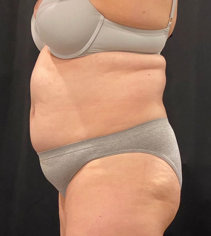 CoolSculpting Before & After Gallery - Patient 364285 - Image 6