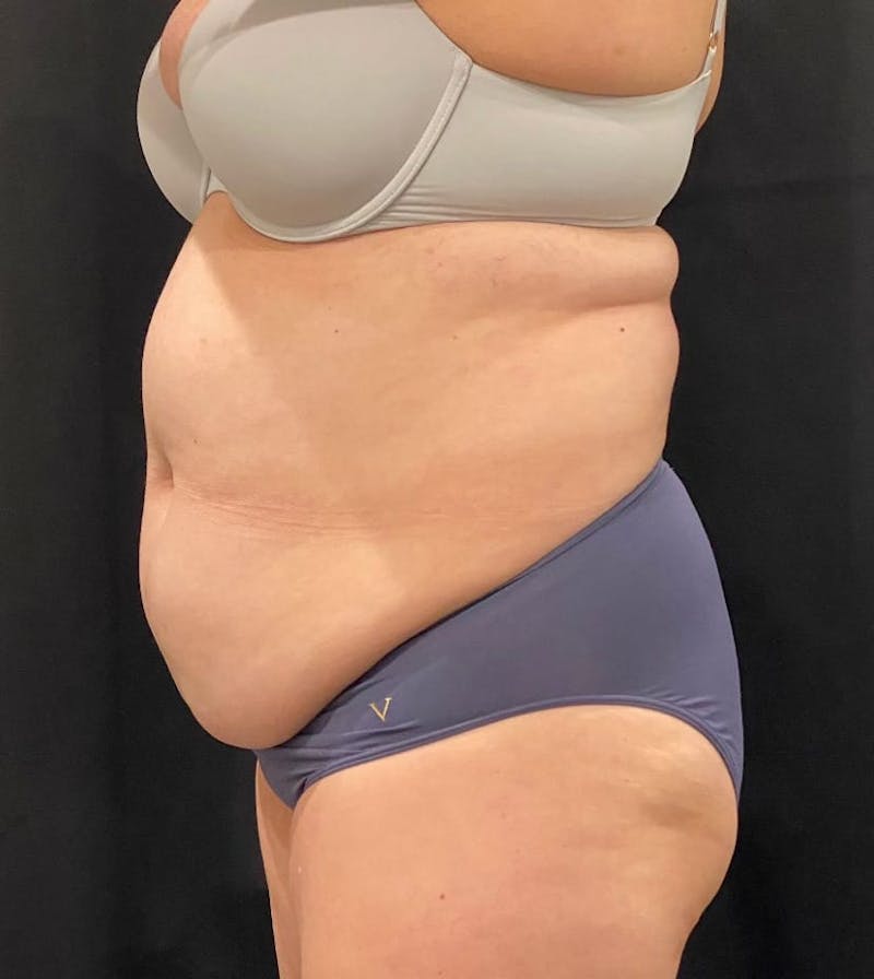 CoolSculpting Before & After Gallery - Patient 364285 - Image 5
