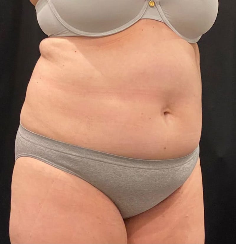 CoolSculpting Before & After Gallery - Patient 364285 - Image 8