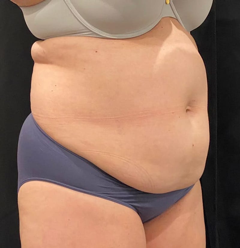 CoolSculpting Before & After Gallery - Patient 364285 - Image 7