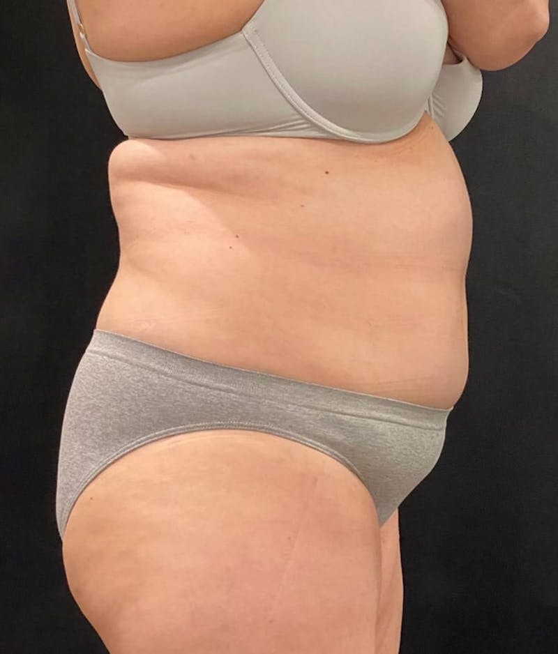 CoolSculpting Before & After Gallery - Patient 364285 - Image 10