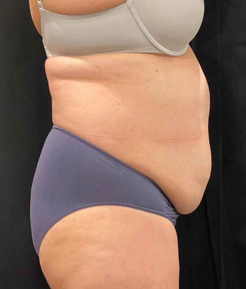 CoolSculpting Before & After Gallery - Patient 364285 - Image 9