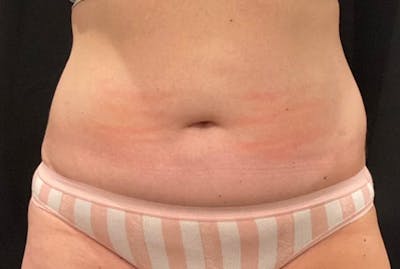 CoolSculpting Before & After Gallery - Patient 263357 - Image 2