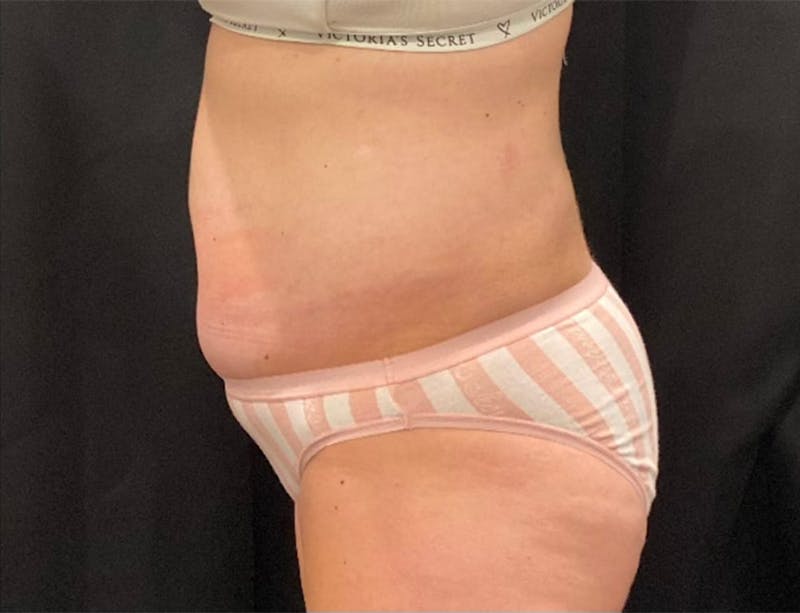 CoolSculpting Before & After Gallery - Patient 263357 - Image 4