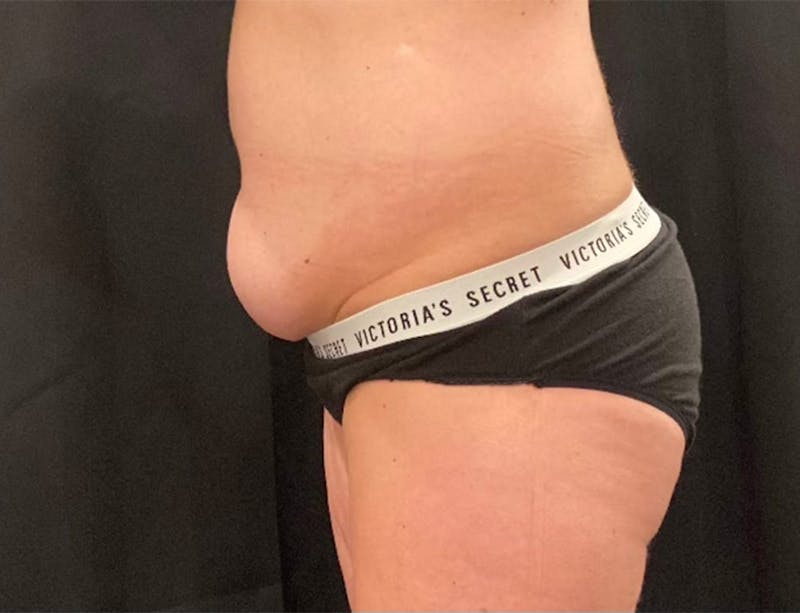 CoolSculpting Before & After Gallery - Patient 263357 - Image 3