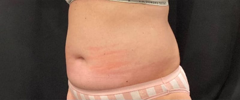 CoolSculpting Before & After Gallery - Patient 263357 - Image 6