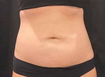 CoolSculpting Before & After Gallery - Patient 272908 - Image 2