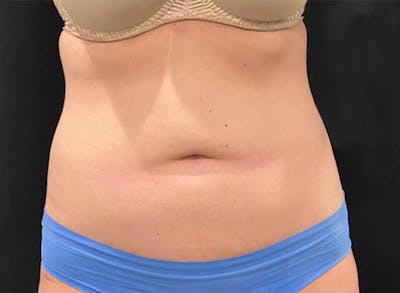 CoolSculpting Before & After Gallery - Patient 272908 - Image 1