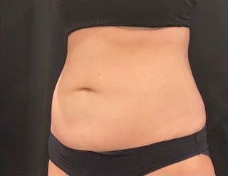 CoolSculpting Before & After Gallery - Patient 272908 - Image 4