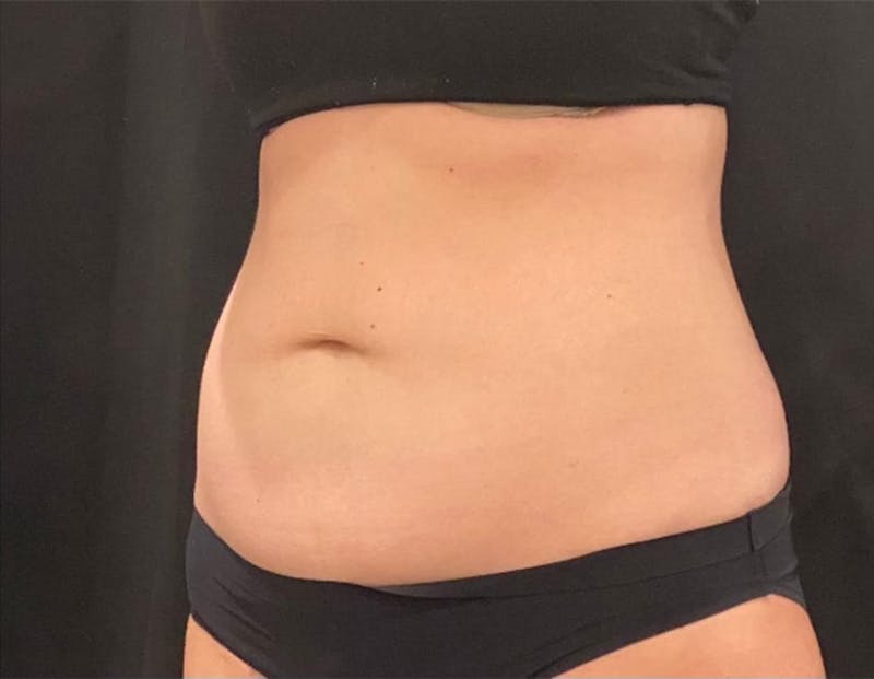 CoolSculpting Before & After Gallery - Patient 272908 - Image 4