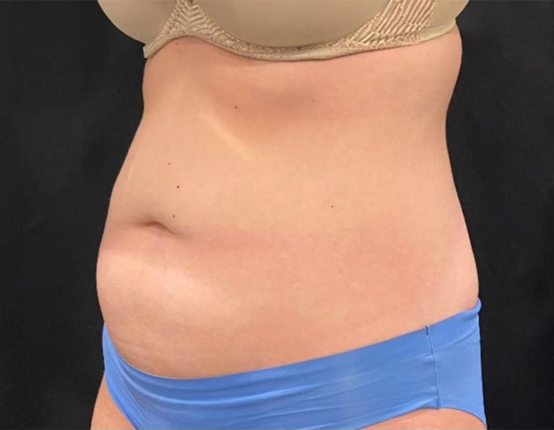 CoolSculpting Before & After Gallery - Patient 272908 - Image 3