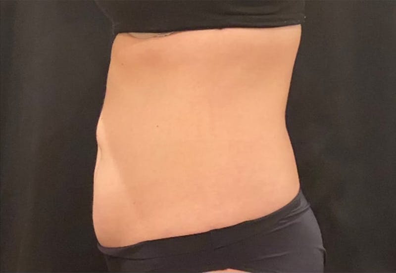 CoolSculpting Before & After Gallery - Patient 272908 - Image 6