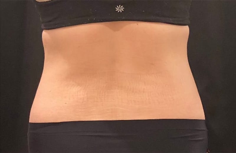 CoolSculpting Before & After Gallery - Patient 272908 - Image 8