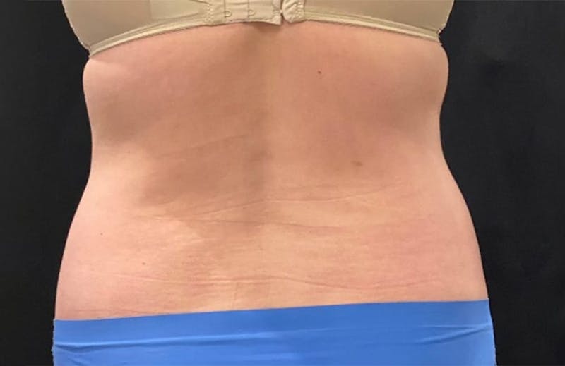 CoolSculpting Before & After Gallery - Patient 272908 - Image 7