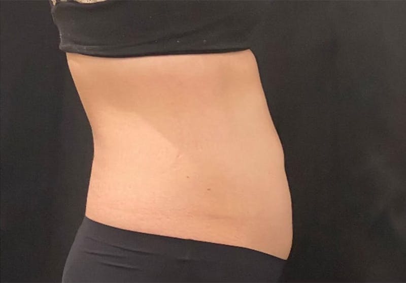 CoolSculpting Before & After Gallery - Patient 272908 - Image 10