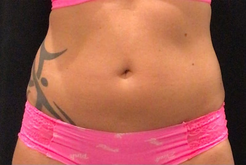 CoolSculpting Before & After Gallery - Patient 436945 - Image 5