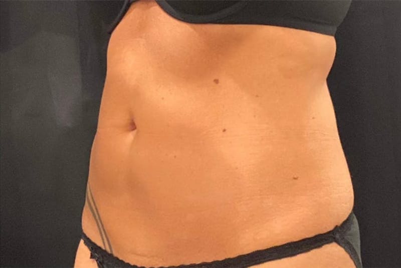 CoolSculpting Before & After Gallery - Patient 436945 - Image 4