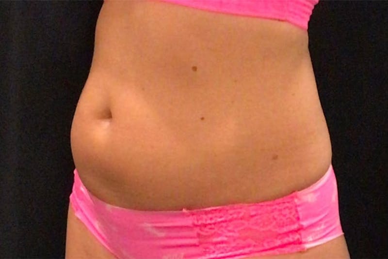 CoolSculpting Before & After Gallery - Patient 436945 - Image 3