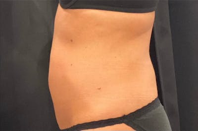 CoolSculpting Before & After Gallery - Patient 436945 - Image 2