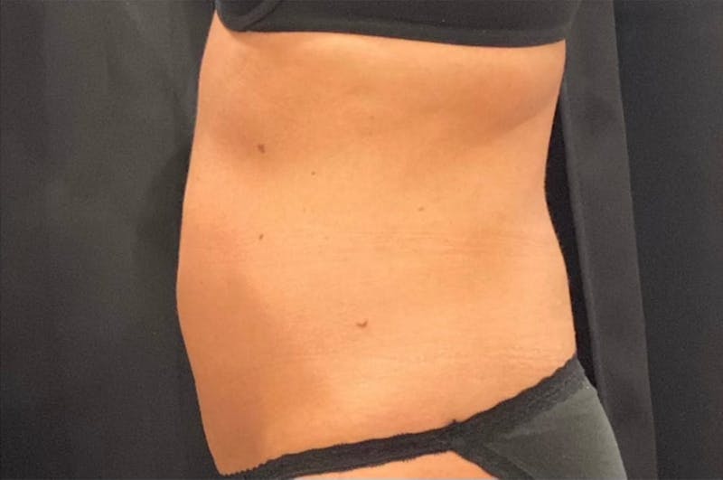 CoolSculpting Before & After Gallery - Patient 436945 - Image 2