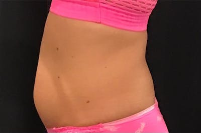 CoolSculpting Before & After Gallery - Patient 436945 - Image 1