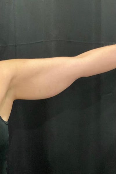 CoolSculpting Before & After Gallery - Patient 428858 - Image 1