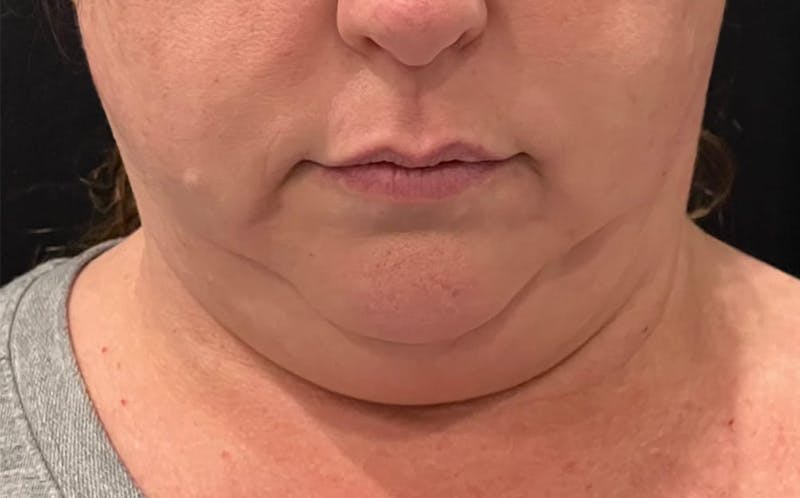 CoolSculpting Before & After Gallery - Patient 369396 - Image 1