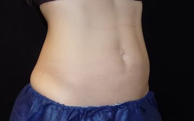 CoolSculpting Before & After Gallery - Patient 974047 - Image 2