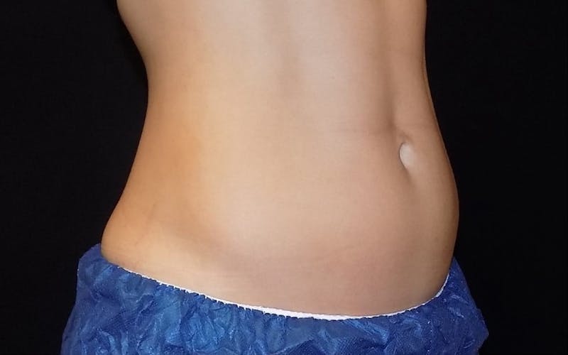 CoolSculpting Before & After Gallery - Patient 974047 - Image 1
