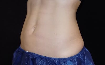 CoolSculpting Before & After Gallery - Patient 311935 - Image 2