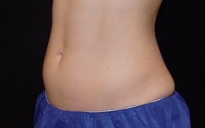 CoolSculpting Before & After Gallery - Patient 311935 - Image 1