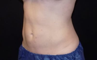 CoolSculpting Before & After Gallery - Patient 395028 - Image 2