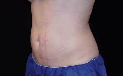 CoolSculpting Before & After Gallery - Patient 395028 - Image 1