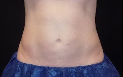 CoolSculpting Before & After Gallery - Patient 140488 - Image 2