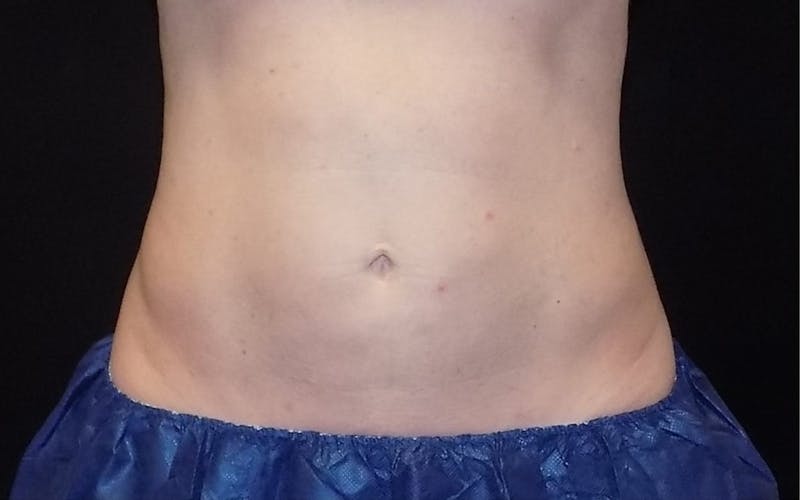 CoolSculpting Before & After Gallery - Patient 140488 - Image 2