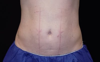 CoolSculpting Before & After Gallery - Patient 140488 - Image 1