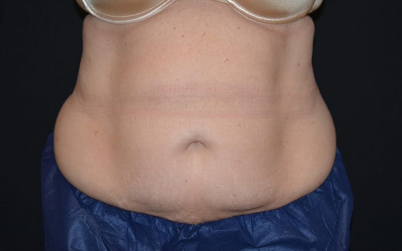 CoolSculpting Before & After Gallery - Patient 402815 - Image 4