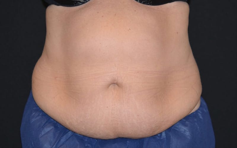 CoolSculpting Before & After Gallery - Patient 402815 - Image 3