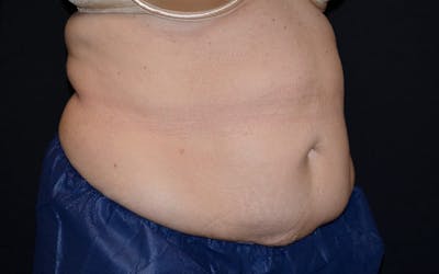 CoolSculpting Before & After Gallery - Patient 402815 - Image 2