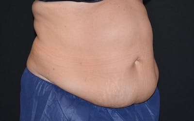 CoolSculpting Before & After Gallery - Patient 402815 - Image 1