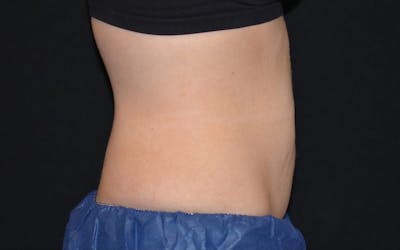 CoolSculpting Before & After Gallery - Patient 942454 - Image 2