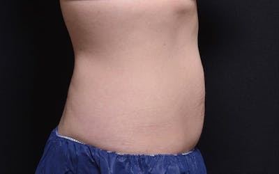 CoolSculpting Before & After Gallery - Patient 942454 - Image 1