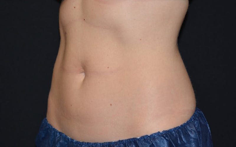 CoolSculpting Before & After Gallery - Patient 324916 - Image 4
