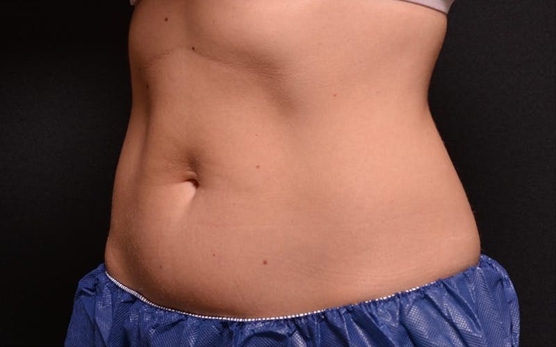 CoolSculpting Before & After Gallery - Patient 324916 - Image 3