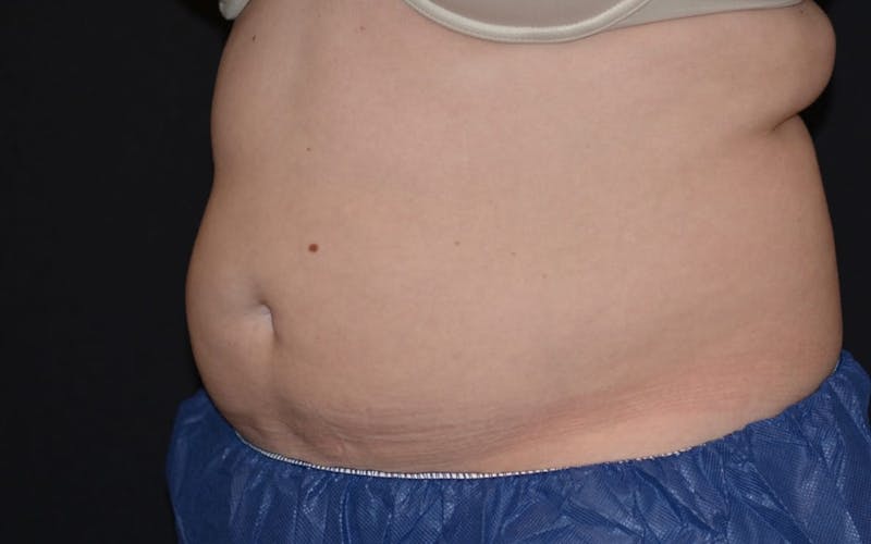 CoolSculpting Before & After Gallery - Patient 216360 - Image 4