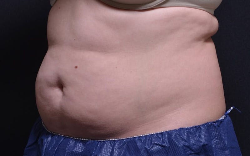CoolSculpting Before & After Gallery - Patient 216360 - Image 3