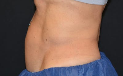 CoolSculpting Before & After Gallery - Patient 278188 - Image 2