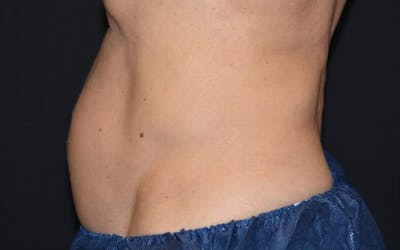 CoolSculpting Before & After Gallery - Patient 278188 - Image 1