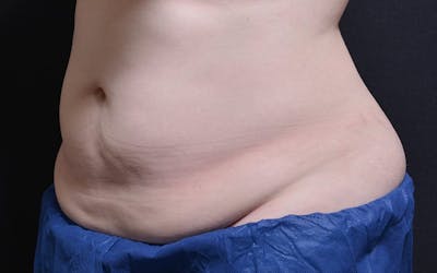 CoolSculpting Before & After Gallery - Patient 158936 - Image 2
