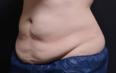 CoolSculpting Before & After Gallery - Patient 158936 - Image 1